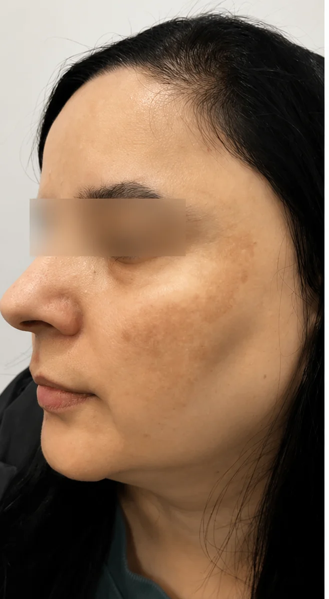 Before pigmentation treatment: brown spots on the cheek