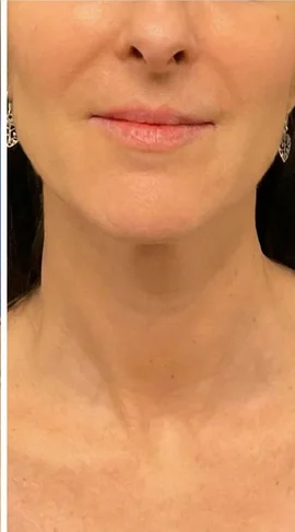 After skin tightening treatment: firmer neck and jawline